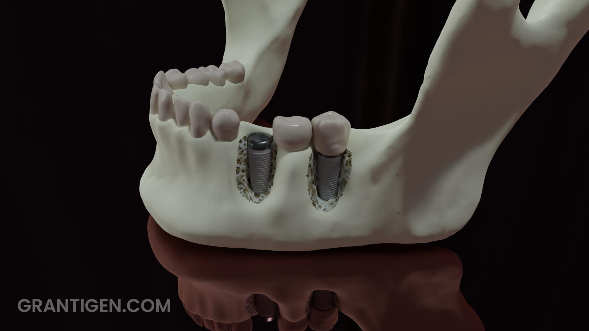 Jaw with titanium dental implants