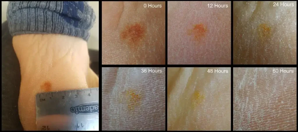 possible acral lentiginous melanoma