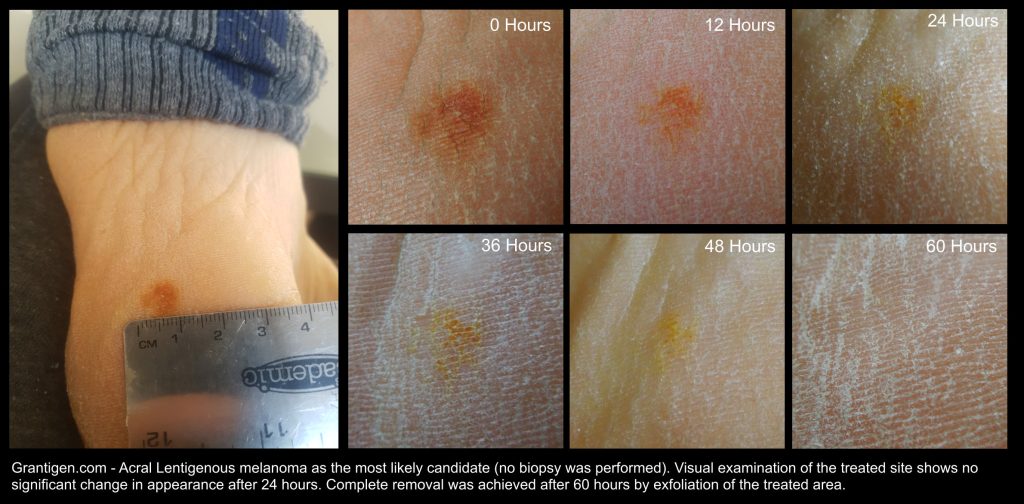 Acral Lentigenous Melanoma