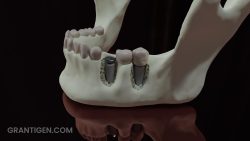 jaw_with_titanium_dental_implants jaw_with_titanium_dental_implants