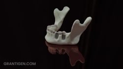 titanium_dental_implants_2 titanium_dental_implants_2
